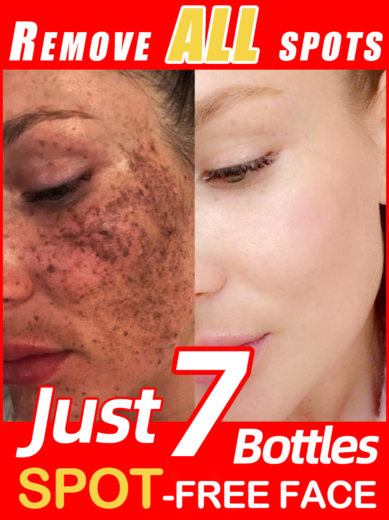 Ultra Luxury Skincare - Schiarire le lentiggini Melasma, macchie scure